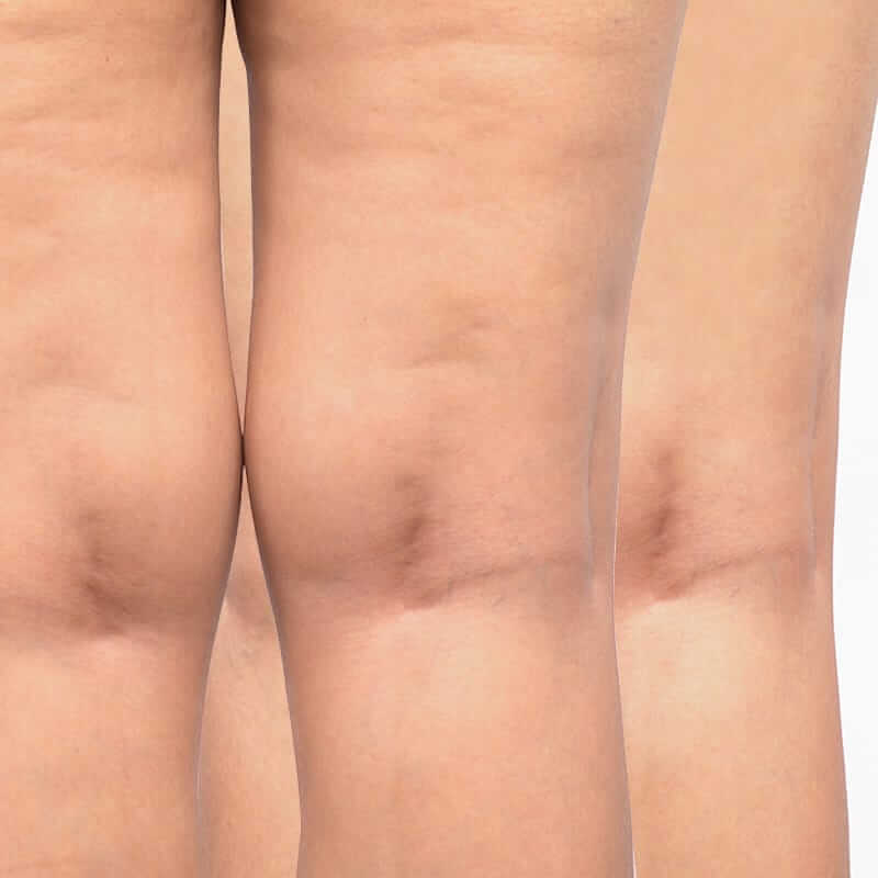 سلولیت و درمان آن